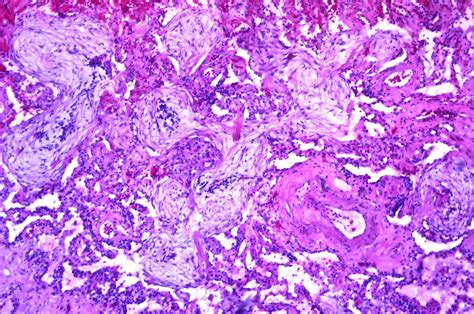 Pathology Outlines Organizing Pneumonia