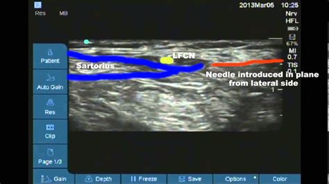 Ultrasound Of The Lateral Femoral Cutaneous Nerve In SexiezPix Web Porn