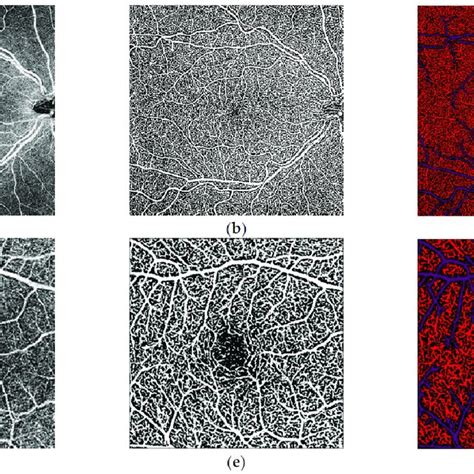 analysis of the macular 10 × 10 mm and 4 × 4 mm optical coherence download scientific diagram