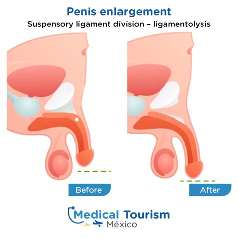 Suspensory Ligament Before And After
