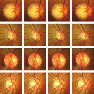 The optic disc is the anatomical location of the eye's blind spot, the area where the optic nerve and blood vessels enter the retina. Measurement of cup-to-disc ratio for a tilted disc. The ...