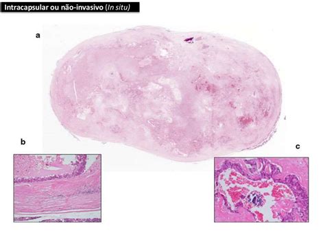 Carcinoma Ex Adenoma Pleomorfico