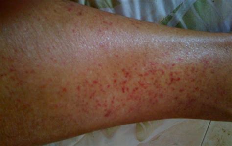 Varicose Veins Rash Pictures Symptoms And Pictures