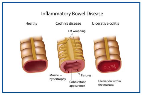 Ibd Inflammatory Bowel Disease Dos And Dontscauses And Risks Treatment