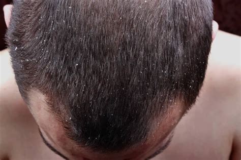 What Causes Dry Scalp Factors Symptoms And Treatments Bald And Beards