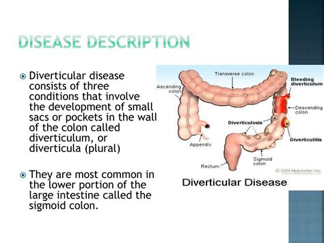Ppt Diverticulosis Diverticulitis Powerpoint Presentation Id Sexiz Pix