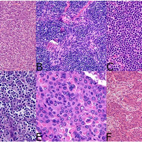 Who Histologic Classification Of Thymoma A Type A Thymoma Is