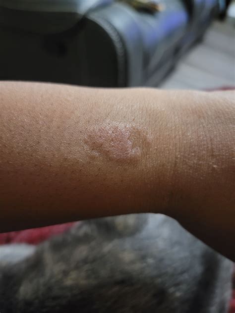 Galaxy Watch 4 Burn On Wrist Samsung Members