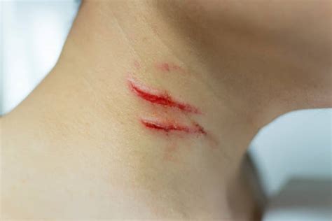 Cuts And Bruises Stock Photos Pictures And Royalty Free Images Istock