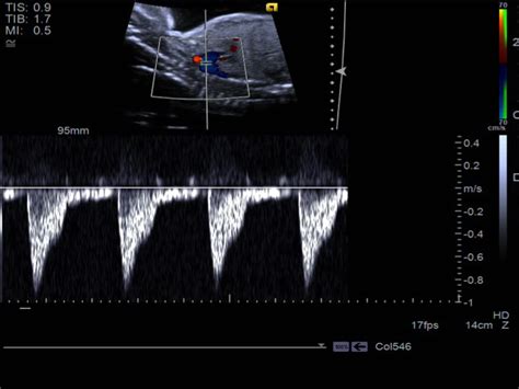Fetal Echo Images Aortic Arch Pediatric Echocardiography