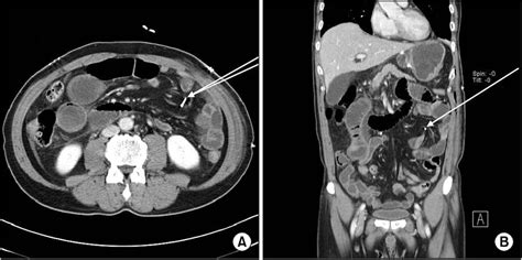 A Preoperative Contrast Enhanced Abdomen Ct Scan Showed Stomach And