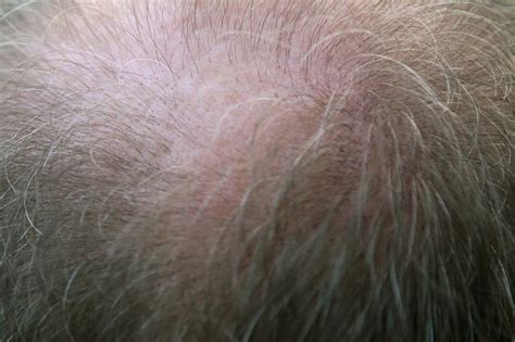Alopecia areata ist ein kreisrunder haarausfall, dessen behandlung bis heute noch nicht gesichert ist. PRP Behandlung bei Haarausfall - volleres Haar fast im ...