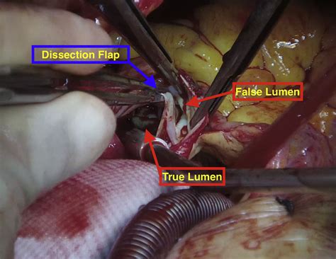 Pulmonary Artery Dissection Associated With Aortopulmonary Artery