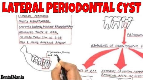 Lateral Periodontal Cyst Pathogenesis Clinical Radiographic And