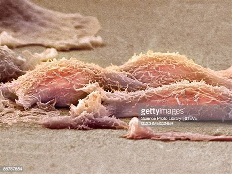 Sarcoma Photos And Premium High Res Pictures Getty Images
