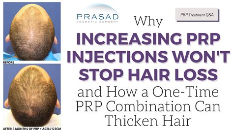 Definitive guide on acell and prp injections for hair loss, including the procedure overview, benefits, risks, recovery, before & after photos, costs, and more. Why Increasing PRP Injections Won't Stop Hair Loss, and ...