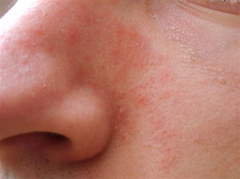 Nose Rash Psoriasis Eczema Fungal Infection At The Truth In