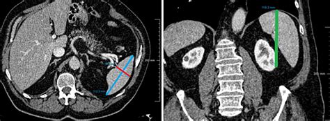 Fully Automatic Volume Measurement Of The Spleen At Ct Using Deep