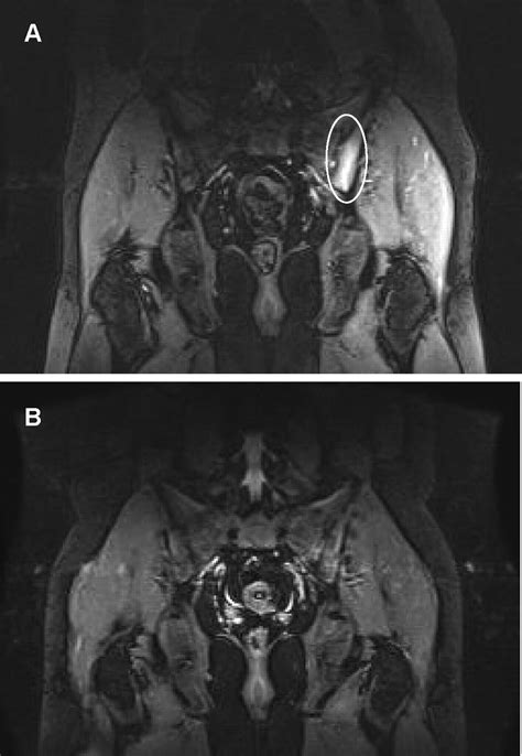 Marked Reduction Of Sacroiliac Joint Inflammation On Magnetic Resonance