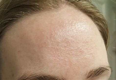 How I Cleared My Tiny Bumps On Forehead Once For All Vrogue Co