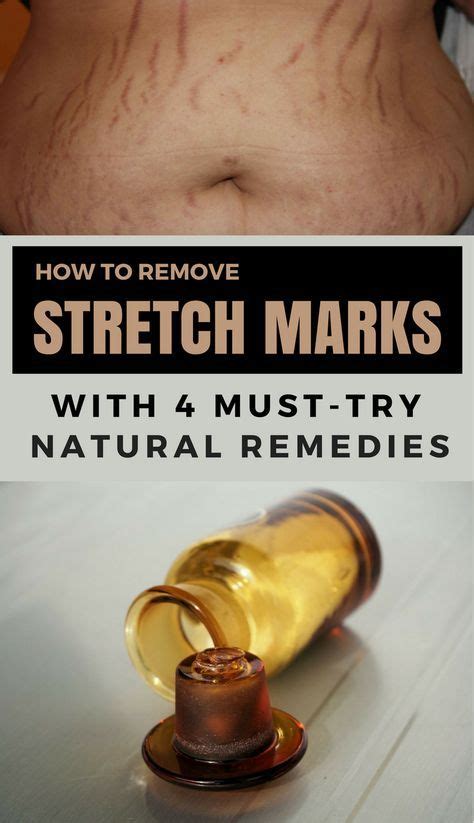 How To Remove Stretch Marks With 4 Must Try Natural Remedies Stretch