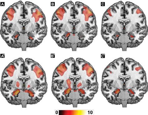 Amygdala Activation During Emotional Face Matching In Healthy Subjects