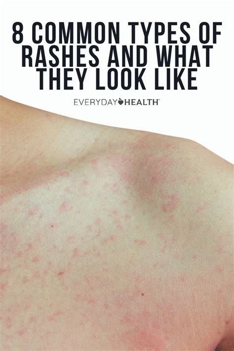 8 Common Types Of Rashes And What They Look Like In 2021 Rashes Heat