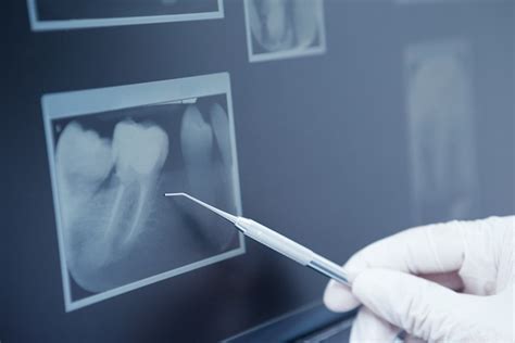 History And Benefits Of Dental X Ray Imaging Artistic Touch Dentistry