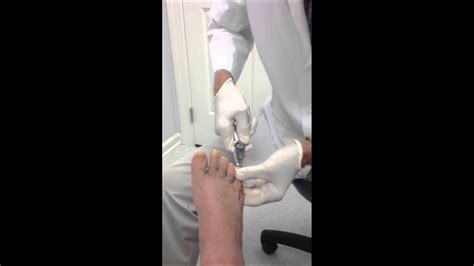 Pin Removal Little Toe Youtube