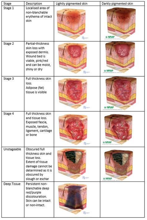 Pressure Ulcer Stages Chart Sexiz Pix