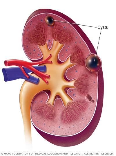How To Prevent Or Solve Kidney Problems What Are The Main Kidney Cyst