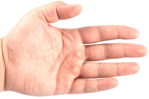 How To Deal With Calluses On Your Hands