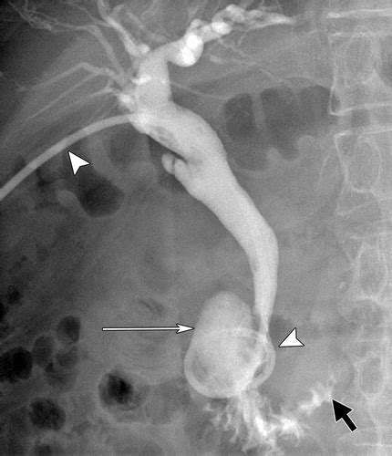 Case 265 Lemmel Syndrome Or Biliary Obstruction Due To A Periampullary