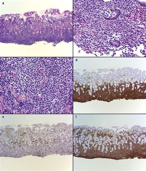 Diagnostic Features Of Gastric Extranodal Marginal Zone B Cell Lymphoma