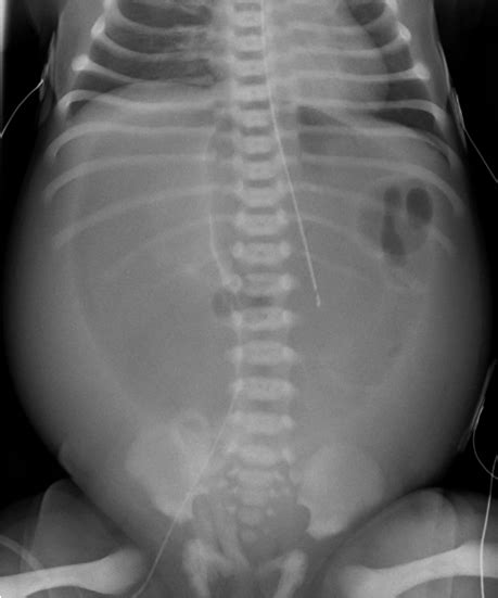 Full Text Neonatal Gastric Perforation A Case Series International