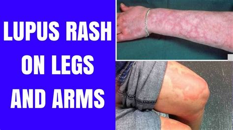 Lupus Rash On Legs Images