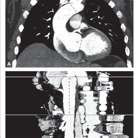 Measuring Ascending Aortic Length By Computed Tomography A Markers