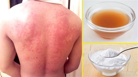 How To Get Rid Of Stress Hives Fast