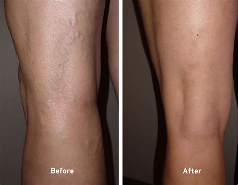 Varicose And Spider Veins Before And After Photos Vein Clinics Of America