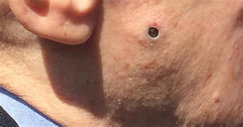 This Man’s Blackhead Imgur