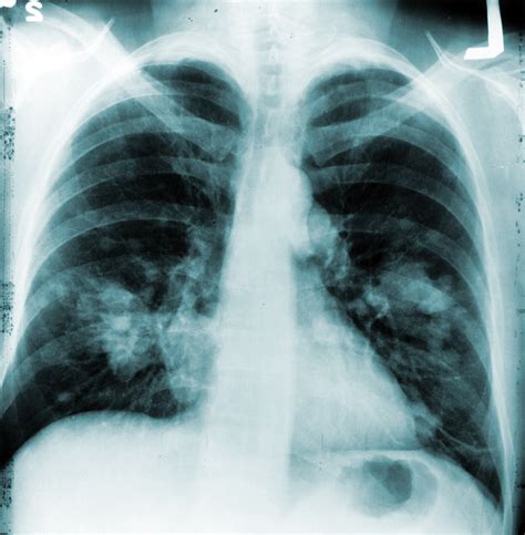 Annual Chest X Rays Dont Cut Lung Cancer Deaths National Institutes