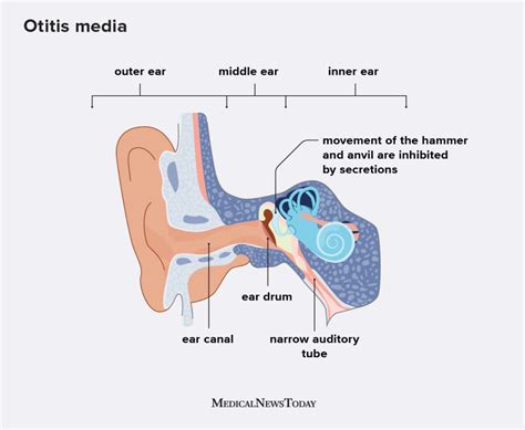symptoms and causes of middle ear infection hearing loss news