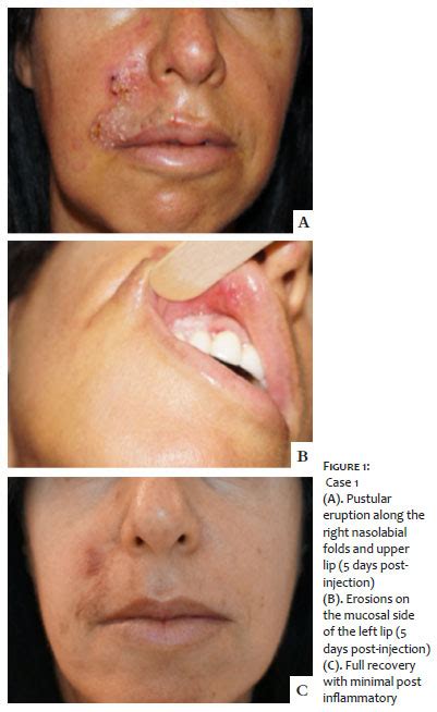 Surgical And Cosmetic Dermatology Pustular Rash After Dermal Filler