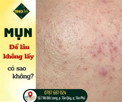 Tuyển Chọn 200 Mẫu Nặn Mụn Giá Sinh Viên được Yêu Thích Nhất