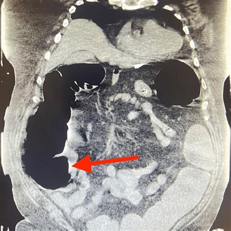Ct Of The Abdomen And Pelvis Without Contrast Showing Dilated Large