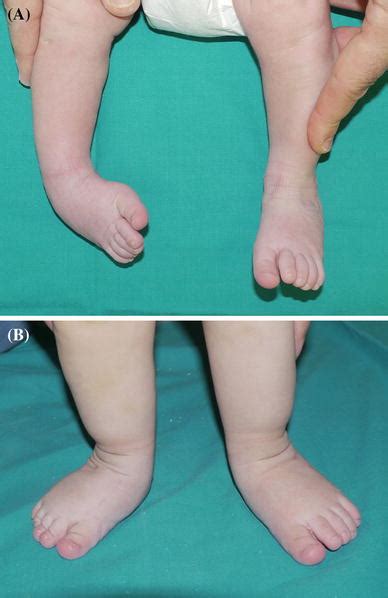 Patients with club feet often appear to walk on their ankles. Podiatry