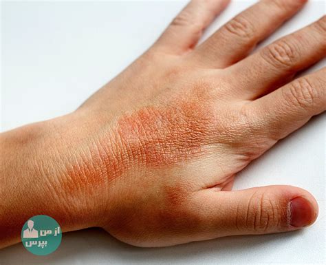 Finger Heat Rash What To Know About Summer Finger Bumps