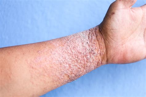 Eczema