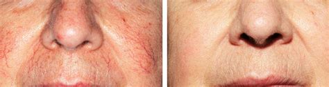 Laser Thread Vein Treatment Services Renew Skin Clinic