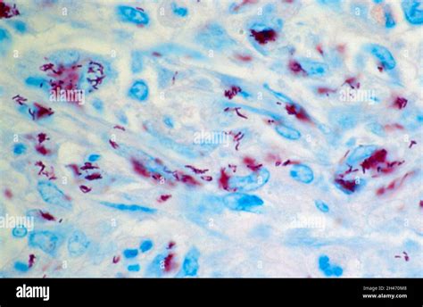 Bone Marrow Mycobacterium Genavense Infection Stock Photo Alamy